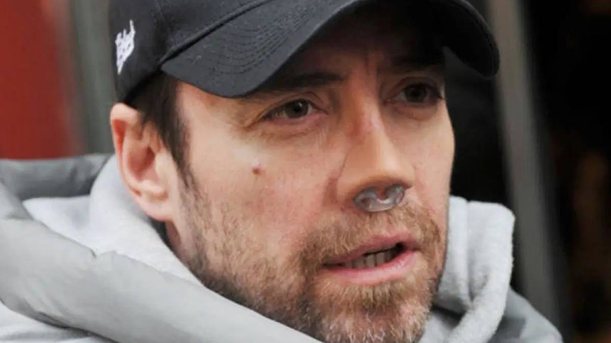 13. kez ameliyat olmuştu… Murat Dalkılıç bandajsız halini ilk kez paylaştı