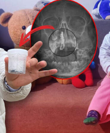 Rize’de Akılalmaz Olay: Küçük Polen’in Burnundan Çıkana Kimse İnanamadı