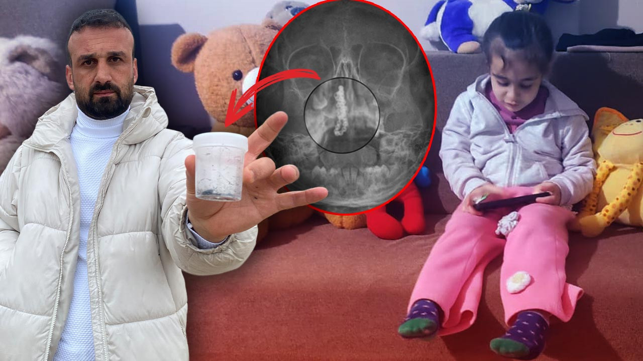 Rize’de Akılalmaz Olay: Küçük Polen’in Burnundan Çıkana Kimse İnanamadı