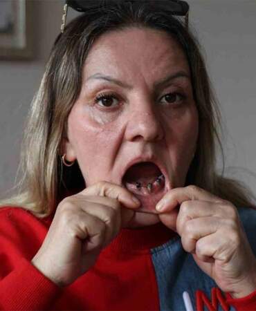 Diş tedavisi kabusa döndü! 25 dişi birden çekildi, ‘ağrıların psikolojik’ denildi