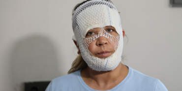 ‘Prenses Bakım’ Değil İşkence! 7 Bin Lira Verdi, 2. Derece Yanıkla Döndü