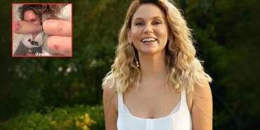 Vücudundaki morluk ve kızarıklıklar korkuttu! Farah Zeynep Abdullah son halini paylaştı