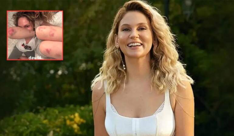 Vücudundaki morluk ve kızarıklıklar korkuttu! Farah Zeynep Abdullah son halini paylaştı