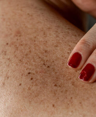 Benlerinizi Sakın Yakmayın! Dermatologdan Hayati Deri Kanseri Uyarısı