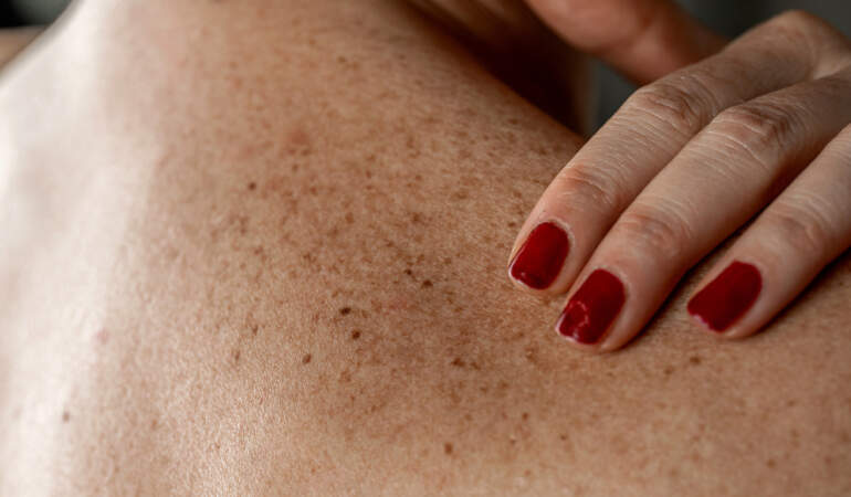 Benlerinizi Sakın Yakmayın! Dermatologdan Hayati Deri Kanseri Uyarısı