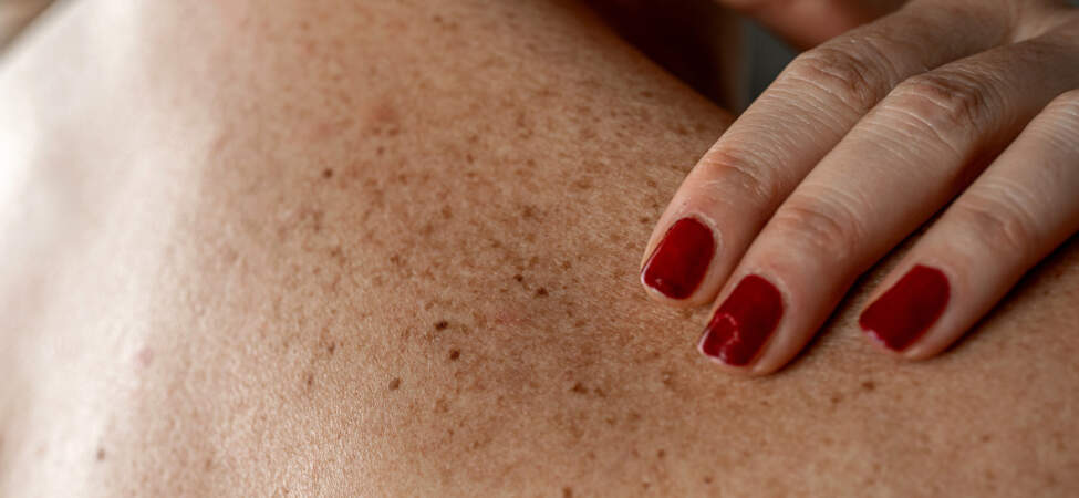 Benlerinizi Sakın Yakmayın! Dermatologdan Hayati Deri Kanseri Uyarısı